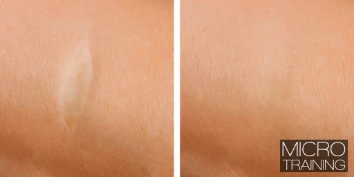 Micro Training Scar Removal Middle East